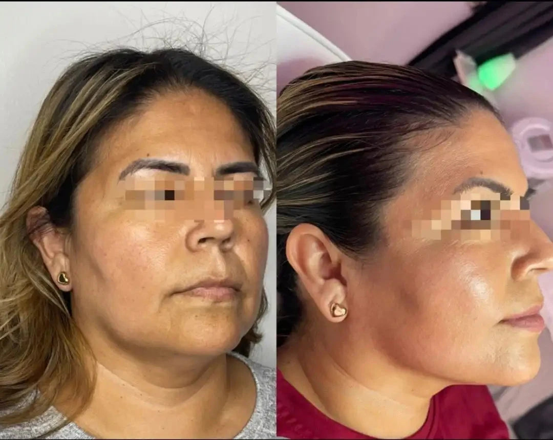 Enzy Dermik Results 2 double chin