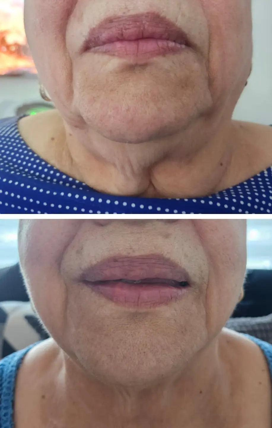 Enzy Dermik Results double chin