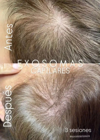 Hair Exosome Dermik 5 x 10ml